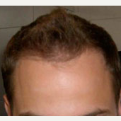 35 year old man treated with Hair Loss Treatment after 3839176