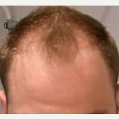 35 year old man treated with Hair Loss Treatment before 3839176