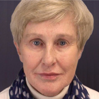65-74 year old woman treated with Injectable Fillers after 3176422