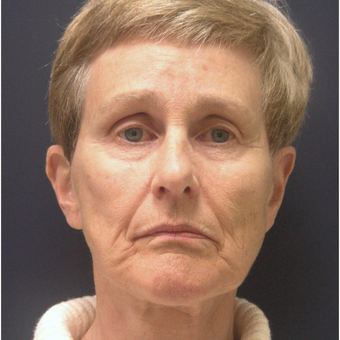 65-74 year old woman treated with Injectable Fillers before 3176422