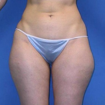 25-34 year old woman treated with Liposuction before 3496823