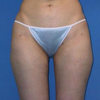 25-34 year old woman treated with Liposuction after 3496823