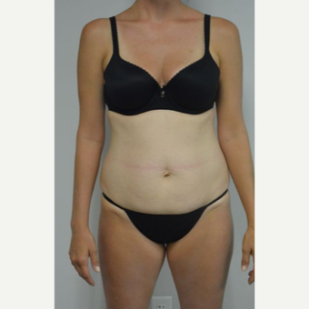 35-44 year old woman treated with Tummy Tuck and liposuction of her flanks and lower back before 3458995