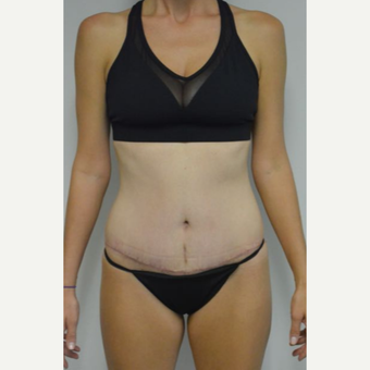 35-44 year old woman treated with Tummy Tuck and liposuction of her flanks and lower back after 3458995