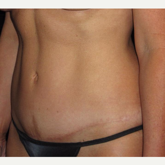 45 year old woman treated with Tummy Tuck before 3252387