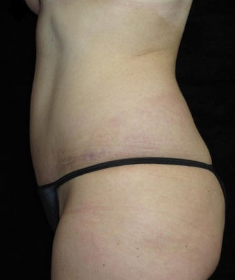 45 year old woman treated with Tummy Tuck 3252387