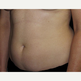 45 year old woman treated with Tummy Tuck after 3252387