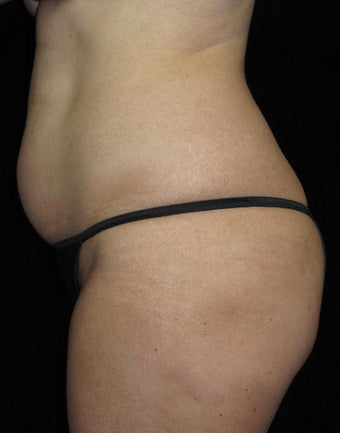 45 year old woman treated with Tummy Tuck 3252387