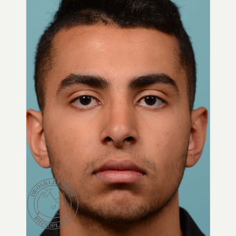 18-24 year old man treated with open Septoplasty/rhinoplasty after 3092822
