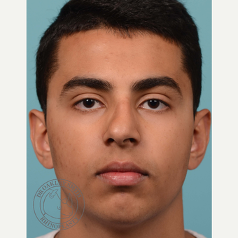 18-24 year old man treated with open Septoplasty/rhinoplasty before 3092822