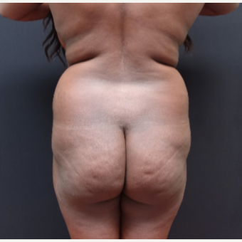 25-34 year old woman treated with Brazilian Butt Lift before 3363798