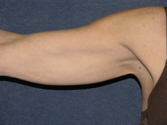 Arm Reduction before 1411225