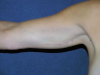 Arm Reduction after 1411225