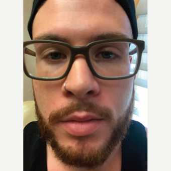 25-34 year old man treated with Injectable Fillers before 3775899