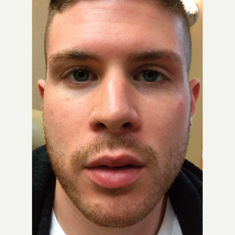 25-34 year old man treated with Injectable Fillers after 3775899
