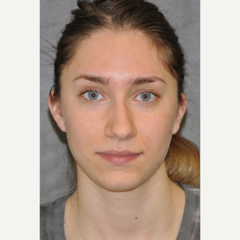 25-34 year old woman treated with Rhinoplasty before 3566003