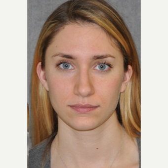 25-34 year old woman treated with Rhinoplasty after 3566003