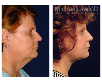 Facial Rejuvenation before 1285294