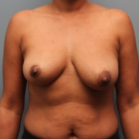 46 year old woman treated with Breast Augmentation before 3390713