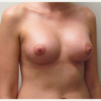 25-34 year old woman treated with Sientra Breast Implants after 2985293