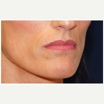 35-44 year old woman treated with Cheek Augmentation before 1569176