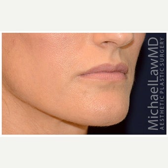 35-44 year old woman treated with Cheek Augmentation after 1569176