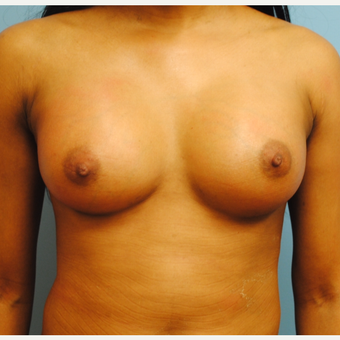 25-34 year old woman treated with Breast Augmentation after 3054573