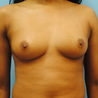 25-34 year old woman treated with Breast Augmentation before 3054573
