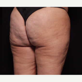 45-54 year old woman treated with Cellfina after 3104557