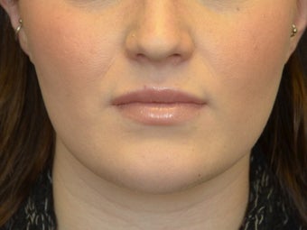 Buccal Fat Removal & Botox Jaw Slimming after 1166426