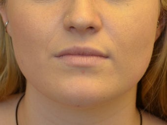 Buccal Fat Removal & Botox Jaw Slimming before 1166426