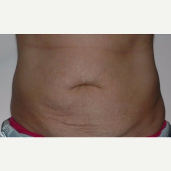 Mommy treated with Tummy Tuck (abdominoplasty) before 2245849