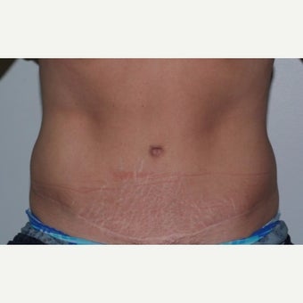 Mommy treated with Tummy Tuck (abdominoplasty) after 2245849