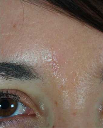 25-34 year old woman treated with Mole Removal after 2465296