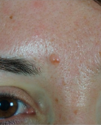 25-34 year old woman treated with Mole Removal before 2465296