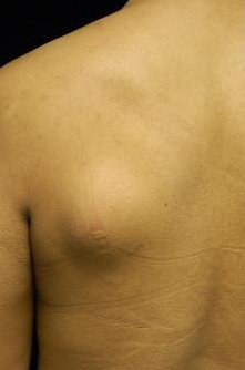 Lipoma Removal with Smartlipo Triplex before 600029