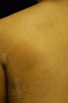 Lipoma Removal with Smartlipo Triplex after 600029