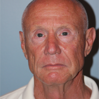 67 year old man treated with LiteLift® Facelift before 3465097