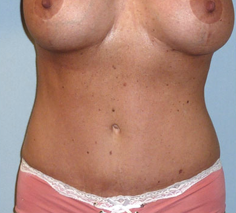 Mommy Makeover after 1069940