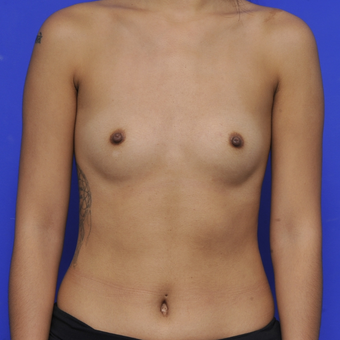 25-34 year old woman treated with Breast Augmentation before 3464039