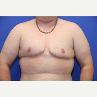 37 year old trans man treated with FTM Chest Masculinization Surgery after 2166612