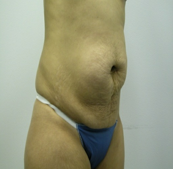 Abdominoplasty before 531875