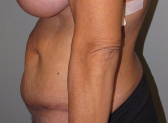 45-54 year old woman treated with Panniculectomy after 3583843