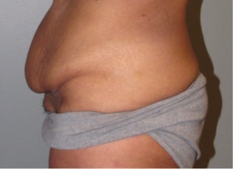 45-54 year old woman treated with Panniculectomy before 3583843