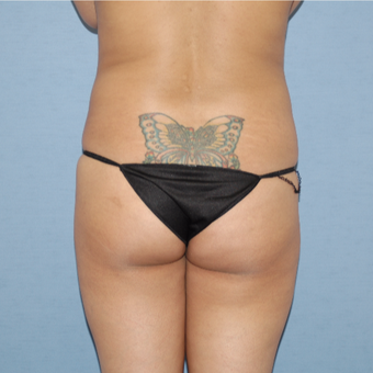 35-44 year old woman treated with Brazilian Butt Lift before 3108482