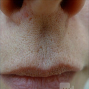 Acne Scars Treatment- TCA CROSS before 1769909