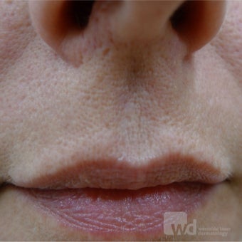 Acne Scars Treatment- TCA CROSS after 1769909