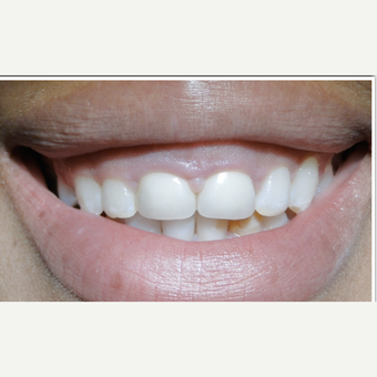 35-44 year old woman treated with Gum Lift before 1692127
