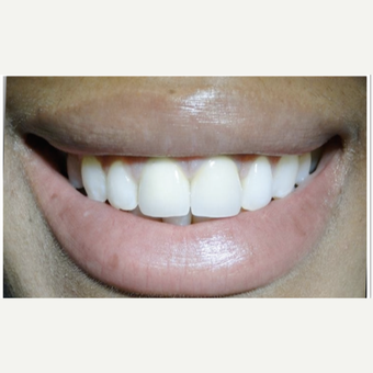 35-44 year old woman treated with Gum Lift after 1692127