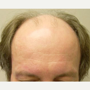38 year old man treated with FUE Hair Transplant before 3564741